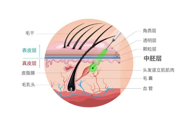 比非那雄胺、米诺地尔更有效的防脱药来了？