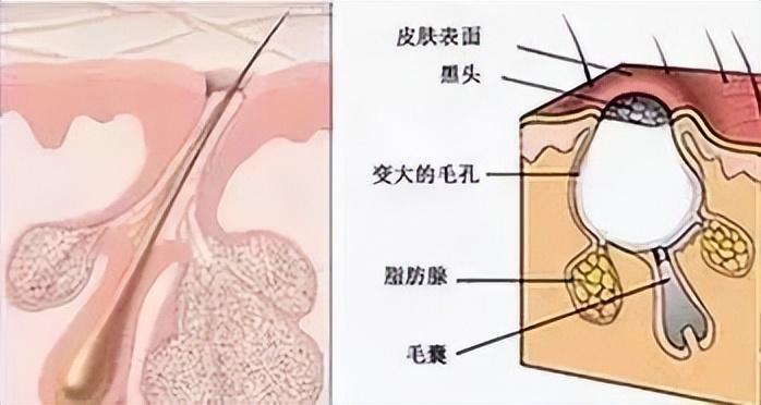 头皮上真的是青春痘吗？最好别抠！