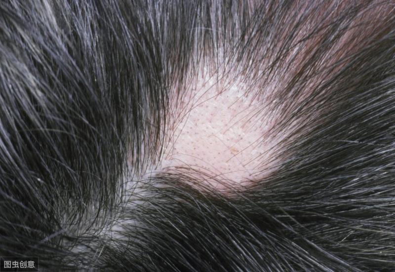 斑秃（Alopecia Areata）常见皮肤病问答健康科普